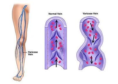 Neoveris sprječava razvoj venskih patologija