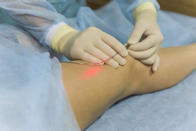 Lasersko liječenje proširenih vena