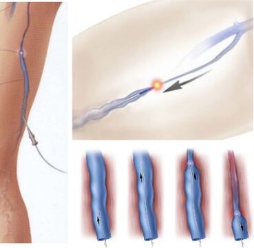 metoda liječenja proširenih vena - endovenska laserska koagulacija